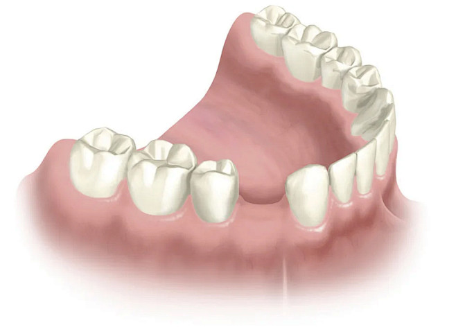 单颗牙缺失