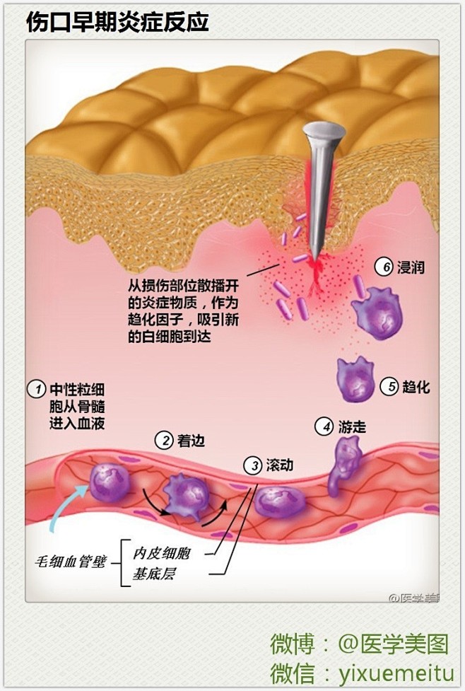 临床笔记 l 伤口早期炎症反应