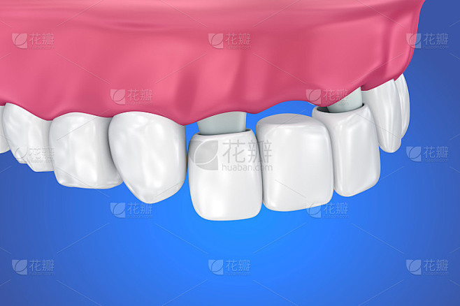牙支撑固定桥。医用精准3D插图