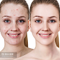 治疗前后有青春痘的年轻女性。Young woman with acne before and after treatment. - 图虫创意-全球领先正版素材库-Adobe Stock中国独家合作伙伴