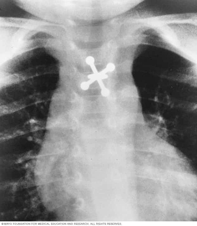 X-ray of swallowed j...