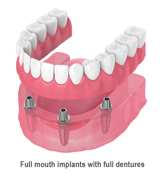 leeming-dental-full-mouth-implants-png-960-1043