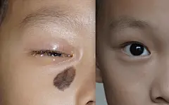修复眼睑色素痣，难点中的难点_眼睑色素痣_眼睑色素痣治疗方式 - 好大夫在线