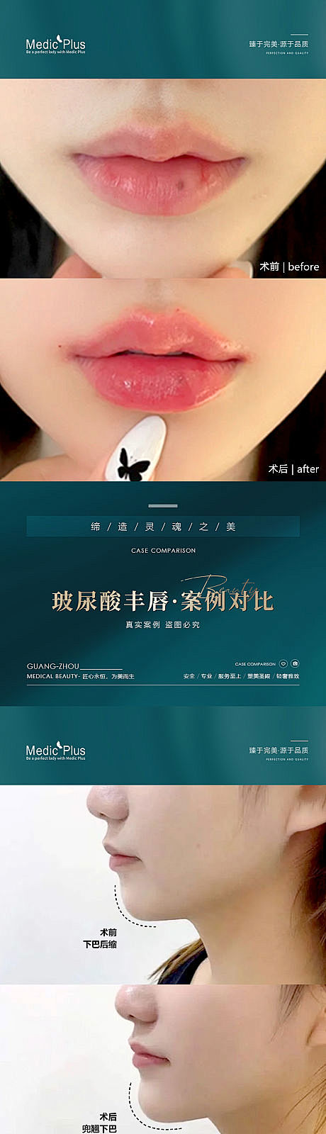医美玻尿酸丰唇案例对比海报-源文件