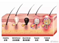皮肤痘痘形成图解