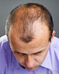 baldness - Google 搜索