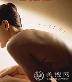 针灸