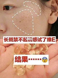 米云: 维E大揭秘，用它祛斑，没想到结果是。 女生真的是好麻烦啊 : 维E大揭秘，用它祛斑，没想到结果是。。。。 女生真的是好麻烦啊， 一不留神就会长斑，平时过度的晒太阳都会长斑，出去旅游的那段时间里，脸上的斑一下子就长出来。上班熬夜加班又是常事，所以后来就开始用各种的