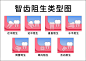 智齿阻生类型图