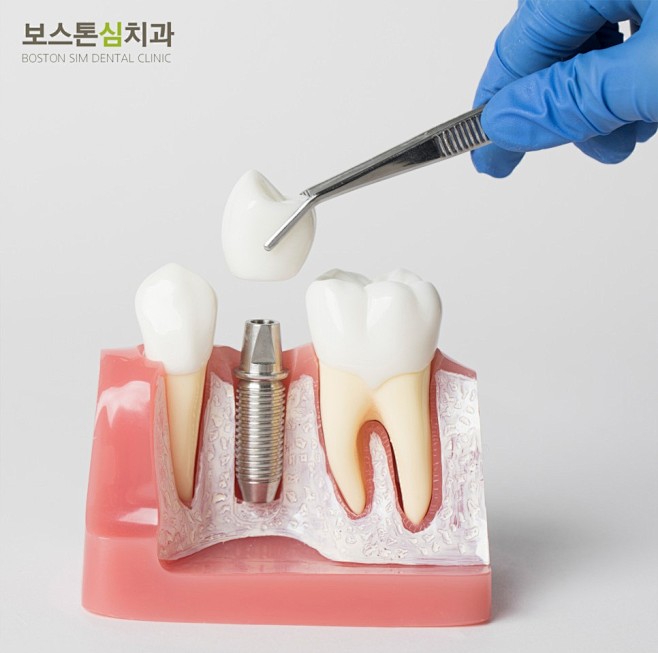 청주앞니임플란트_8.JPG (966×...