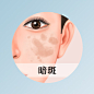 暗斑