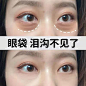 眼袋前后对比的搜索结果_百度图片搜索