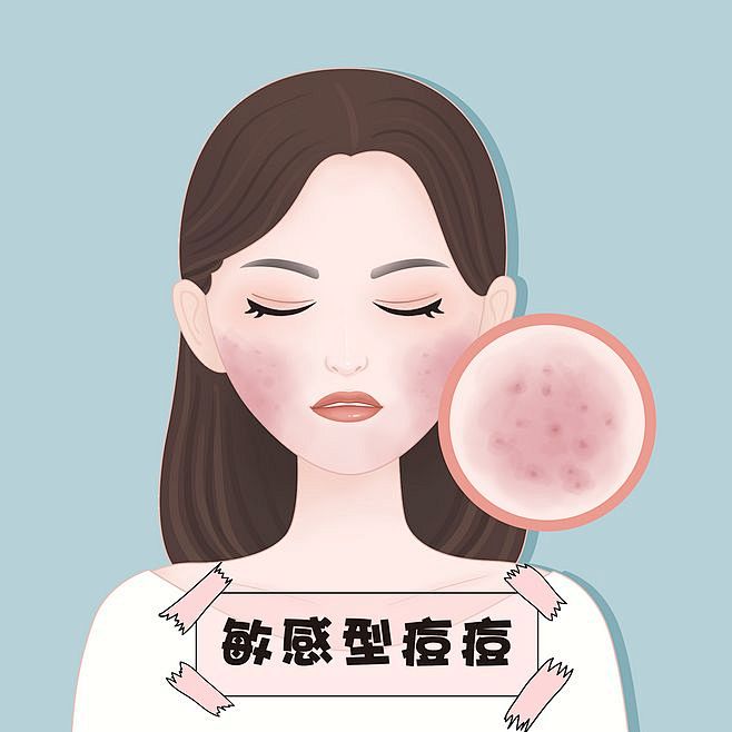 医美插画从插画&设计转采于2020-03-21 11:56:29白头粉刺 感染型痘痘