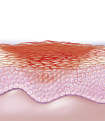 Eczema Illustration