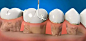 精美图解牙周的深度治疗——龈下刮治术,口腔保健,龈下刮治术,龈下刮治,牙周病,牙科网www.yake.net.cn