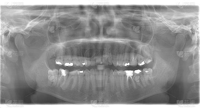 Orthopantomogram