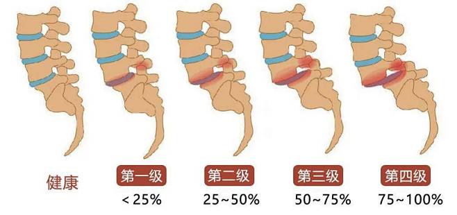 【章老三分享】腰痛的主要原因有哪些！_腰...
