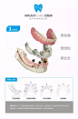 IMPLANTGUIDE™数字化全程种植导板病例分享_临床 : IMPLANTGUIDE™数字化种植全程解决方案，是数字化时代种植技术的发展方向。通过数字化，实现精准，微创，以修复为导向的种植，使医生轻松完成手术，使患者减轻术中、术后的痛苦。 本病例由史俊宇医生倾情分享 “