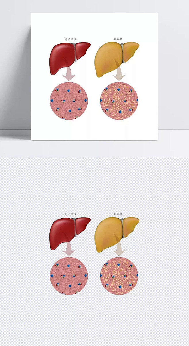 正常肝脏和脂肪肝对比图|脂肪肝,对比图,正常肝脏,酒精肝,卡通元素,手绘/卡通