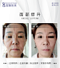 医疗美容整形微整美容院案例对比手术对比效果图设计