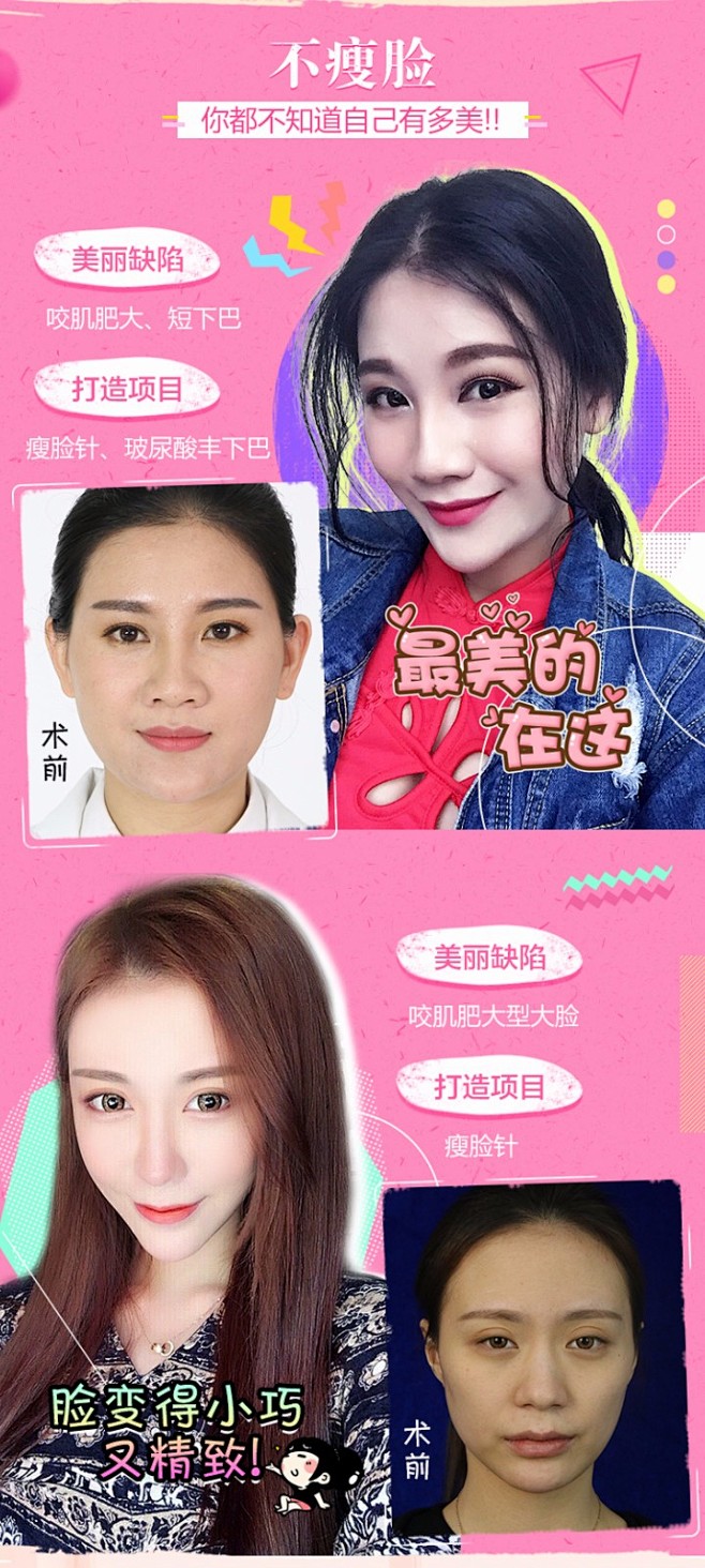 注射微整|广州衡力瘦脸针 100单位 专...