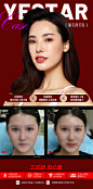 玻尿酸丰唇案例对比-志设网-zs9.com