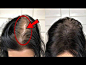 How To Increase Volume And Density Of Hair / Dr. Vivek Joshi