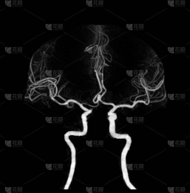 脑或CTA脑显示脑动脉的CT血管造影.