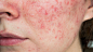 Facial redness, acne Compared - Google 搜尋