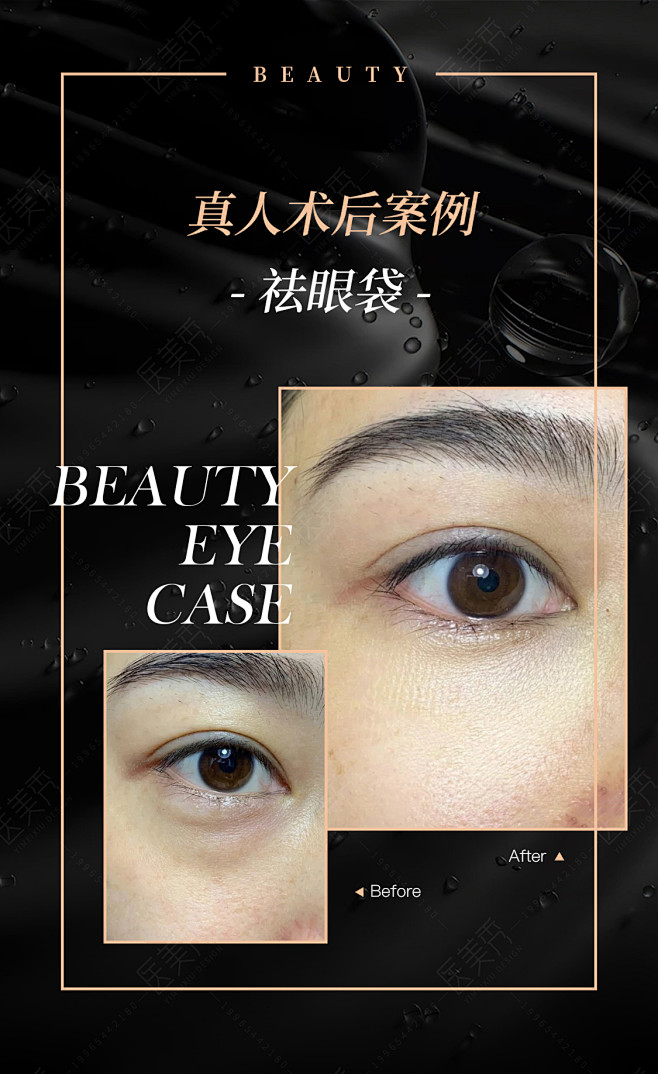 包月整形眼部案例对比图设计