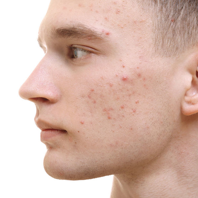Man with red acne so...