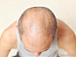 baldness - Google 搜索