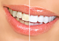 全部尺寸 | teeth whitening | Flickr - 相片分享！