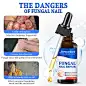 Jemeesen-Fungal-Nail-Repair-描述_03