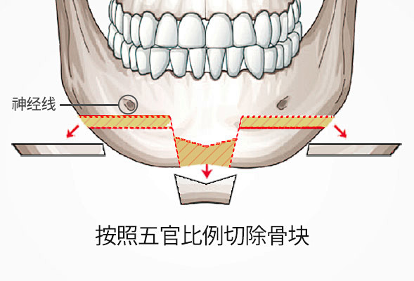 V-line下颌角手术