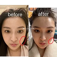 终于把贵妇医院的价格压下来了，我的第一个热玛吉团来了！首先和大家保证：价格、发数、医生级别和我做的一摸一样，保证正品，自己做的探头可以拿走。
项目内容：
热玛吉5代900发送m22全模式
（台湾医生操作）
价格：老板不让说，私我吧，哎，心累
（这个是底价了，也是我做的价格，医院对外公开报 ​​​​...展开全文c