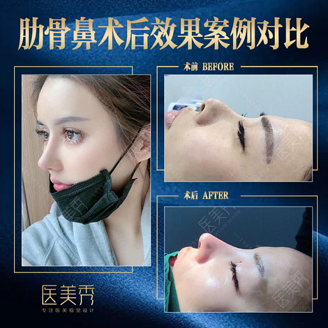 医美对比图鼻子