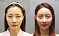 为什么有人脂肪填充后，惨变充气娃娃＋面瘫脸 : 哇，这个人脸好膨胀啊，不太正常！