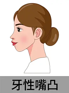 女孩侧脸-牙性嘴凸