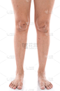 腿,女人,疤,特写,健康保健,部分,背景分离,药,皮肤病学,2015年