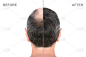 后视图的男性头部之前和之后的头发接发