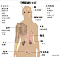 纤维肌痛综合征