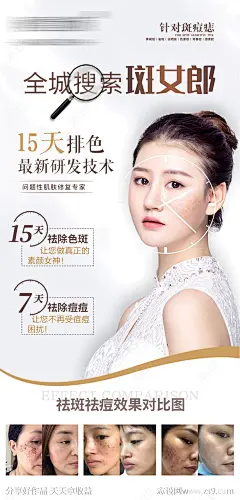 美白祛斑案例活动海报-源文件-志设网-zs9.com