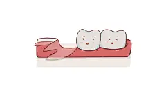 拔智齿  智齿  拔智齿过程  阻生智齿  关于拔智齿  简单智齿拔除  智齿蛀牙  智齿歪斜  侵犯邻牙  无对咬合  萌出时肿胀疼痛  上颌常规智齿  智齿拔除   微创拔智齿  牙龈肿胀  影响邻牙  阻生牙  爱吃歪斜  拔上颌牙智齿  微创拔牙过程  
