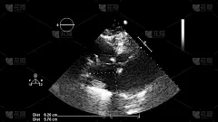 经食管超声检查心脏图像。