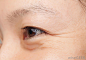 wrinkles-around-the-eyes.jpg (1000×694)