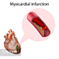 心肌梗死。心脏病发作。病媒医学解剖图。,Myocardial infarction. Heart attack. Vector medical anatomy illustration. - 图虫创意-全球领先正版素材库-Adobe Stock中国独家合作伙伴