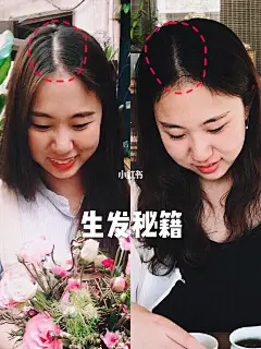 养生老阿姨的防脱生发秘籍！ : 中分十来年导致我头发中分那条线上，以及发际线中间的位置越来约秃，去做个发型都会被发型师diss那种，说我再不救就没救了，我能怎么办，救呗！跟理发师还有朋友取经后就开始尝试，什么洗发水呀，食补呀，按摩呀