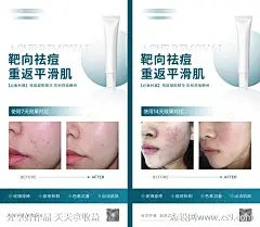 祛痘凝胶精华使用效果对比海报-素材库-sucai1.cn