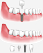 牙齿和牙龈矢量图eps免抠素材_新图网 https://ixintu.com 牙齿 牙龈 种牙 牙齿矢量图 牙齿png